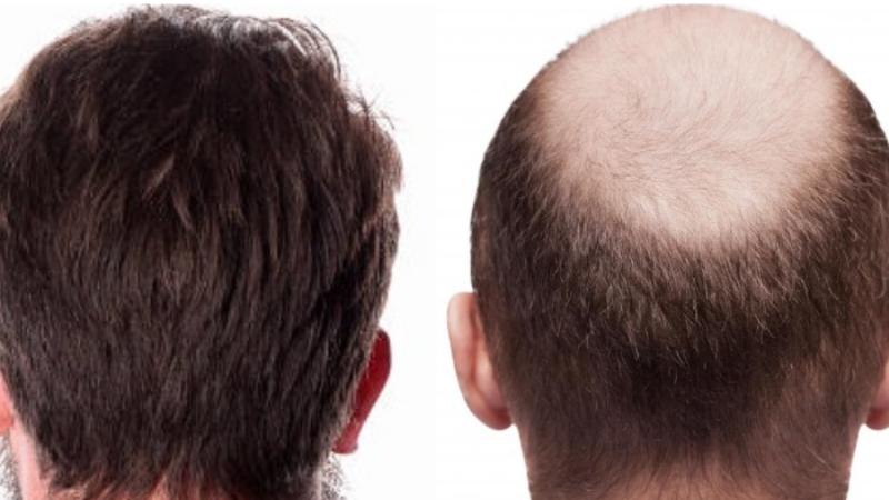 Benefits of FUE over the Older Methods